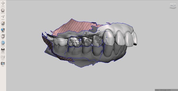 Patients scanned dentition in the designing 3D software