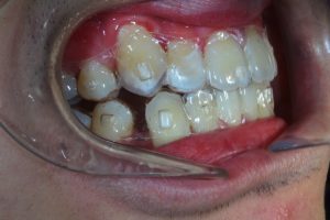 Patients scanned dentition in the designing 3D software
