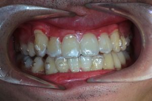 Patients scanned dentition in the designing 3D software