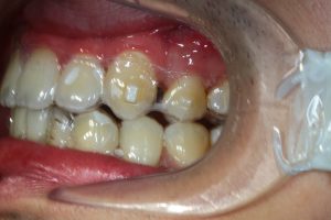 Patients scanned dentition in the designing 3D software