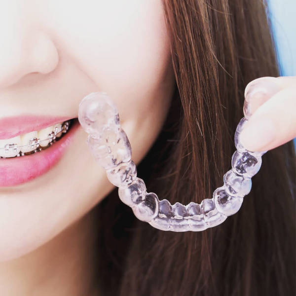 Date With The Dentist? Your Clear Aligners' Worries Answered